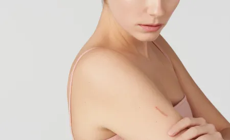Bioderma - woman with scar