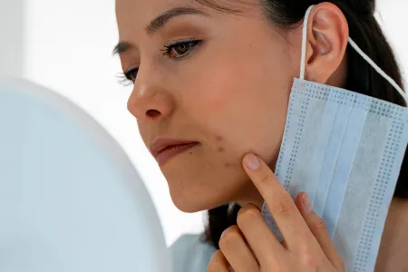 Maskné, mujer con granos en la barbilla por la mascarilla